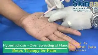 BOTOX Treatment for Sweaty Hands, Palms & Feet at Skinaa Clinic, Jaipur