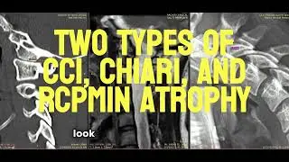 Two Types of CCI, Chiari, and PCPMin Atrophy