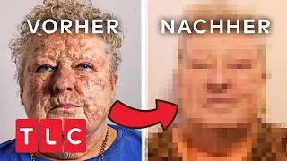 Entstellt und isoliert | Dr. Emma - Haut&auml;rztin aus Leidenschaft  | TLC Deutschland