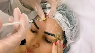 BOTOX NA TESTA. Meu primeiro Botox - v&iacute;deo Passo a passo da aplica&ccedil;&atilde;o.