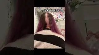 My hair loss journey #alopecia