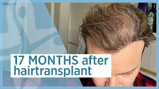 17 months after hairtransplant - Elithairtransplant Dr. Balwi Turkey