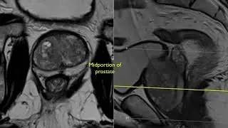 Prostate Anatomy MRI