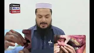 60% Oral Cancer Patients Used Naswar &ndash; KMU Study Uncovers Dangerous Trend