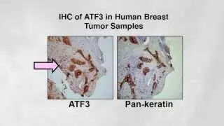 Transcription factor ATF3 links host adaptive response to breast cancer metastasis
