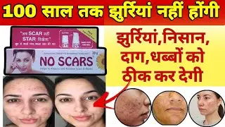 No scars cream || how to use,benifits,sideeffects in hindi || No scars kase cream hai ?