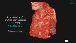 Extraction for 3D printing from a cardiac MRI