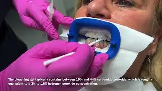 Power bleaching (Tooth whitening) explained in 100 seconds