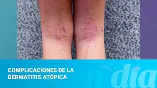 Complicaciones de la dermatitis at&oacute;pica