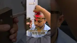 DHI Technique Delivers Real Results &ndash; See This Amazing Hair Transplant Outcome #hairtransplant #DHI