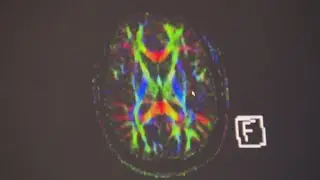 Rethinking recovery: New concussion treatment helps young athletes heal faster