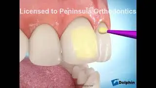 Indirect Bonding (Self-Etching Primer)
