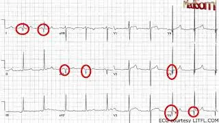 PRACTICE ECG 5