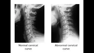 What Is A Cervical Curve?...and why is it important?