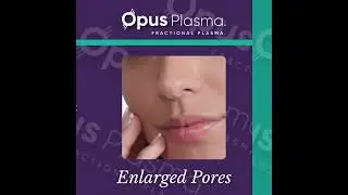 Struggling with enlarged pores?  #enlargedpores