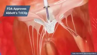 Medtech in a Minute: FDA Approves Abbott's TriClip and ZimVie Sheds Spine Business