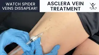 Watch Spider Veins Disappear with Asclera Vein Treatment