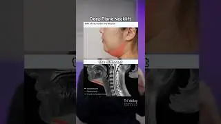 Deep Plane Neck Lift Explained