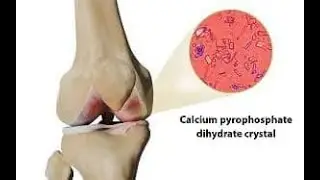 calcium pyrophosphate deposition disease CPPD or pseudogout; deposition of crystals in cartilage