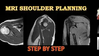 MRI Shoulder Planning easy language #mri#shoulder#ct#planning