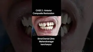 CASE 2 : ANTERIOR COMPOSITE RESTORATION I Dr. Bimal Chand I