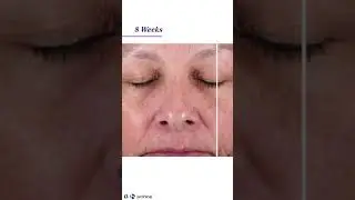 ✨ ACTIVE PEEL SYSTEM iS Clinical Canada - Lumilaser Esthetics