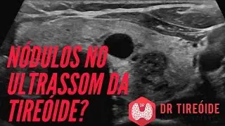 Ultrassom da tireóide - Saiba como avaliar os nódulos!  | Dr Jônatas Catunda