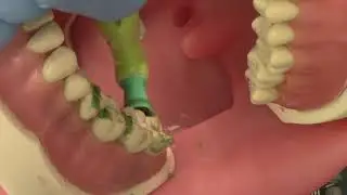 Coronal Polishing