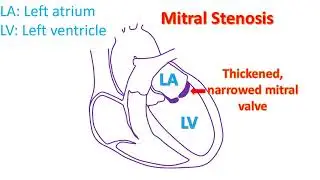What is balloon mitral valvotomy  (BMV/PTMC)?