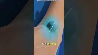 Ganglion Cyst Removal Surgery #relaxingmusic #adventure #music #love #doctor #musicaladventures