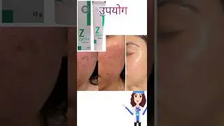 Zyclin Nano Gel Uses in Hindi इस्तेमाल का तरीका? Clindamycin Phosphate 1%