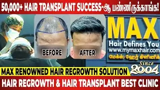 Top Celebrities Hair Treatment-க்கு இங்கதான் வருவாங்க! | Max Hair Clinic | Hair Regrowth | Hair Loss