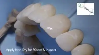 DMG ICON &ndash; Trattamendo delle White Spot - Protocollo Step by Step (EN)