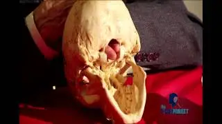 Understanding Chiari Malformation