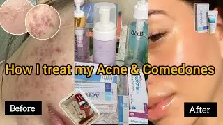 Medicated Skincare | how to treat closed comedones, acne, pimples, pigmentation, scars & open pores 