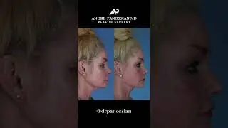 Facelift Before and After | By a Deep Plane Facelift Expert