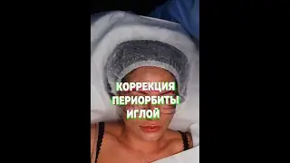 Процедура антивозрастной коррекции кожи вокруг глаз игольными техниками. Aurevitelli 3D EYES