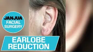 EARLOBE REDUCTION- DR. TANVEER JANJUA - NEW JERSEY