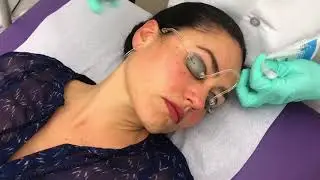 IPL (photo genesis) treatment by dr Yagudin