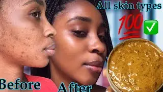 Get rid of bad dull skin in 7days!! BEST AFRICAN BLACK SOAP FOR ACNE SCARS 2022