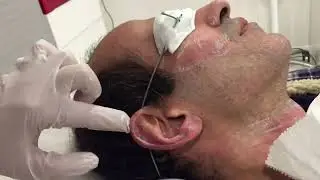 Laser hair Removal for men. Cheeks and ears