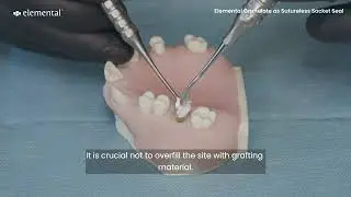 Using Elemental - A Hands-On Sutureless Socket Seal in Alveolar Ridge Preservation Techniques