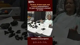 35 olives, 28 date seeds, and 5 stones removed from a 92-year-old woman&rsquo;s stomach in Turkey #doctor