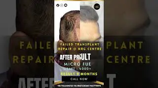 Failed Hair Transplant | Redo by Nrg wellness | Hair transplant #besthairtransplantclinic