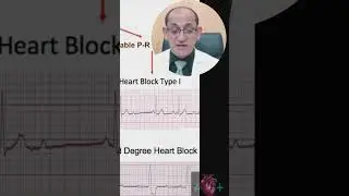 AV BLOCK ECG 2