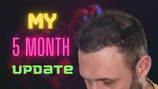 Month 5 - My Hair Transplant Journey 2.0 With ElitHair Istanbul and Dr Balwi