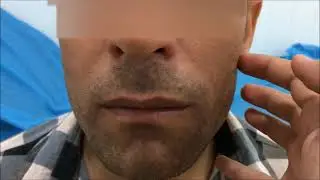Chvostek and Trousseau sign of latent tetany
