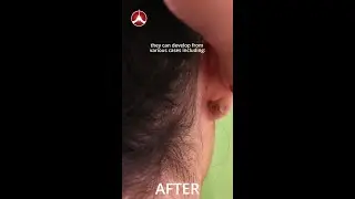 What Causes Keloids?