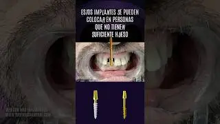 DIENTE FIJO SIN CIRUG&Iacute;A en POCAS HORAS con IMPLANTE MONOF&Aacute;SICO