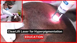 ClearLift Laser Treatment on Hyperpigmentation | Part 1